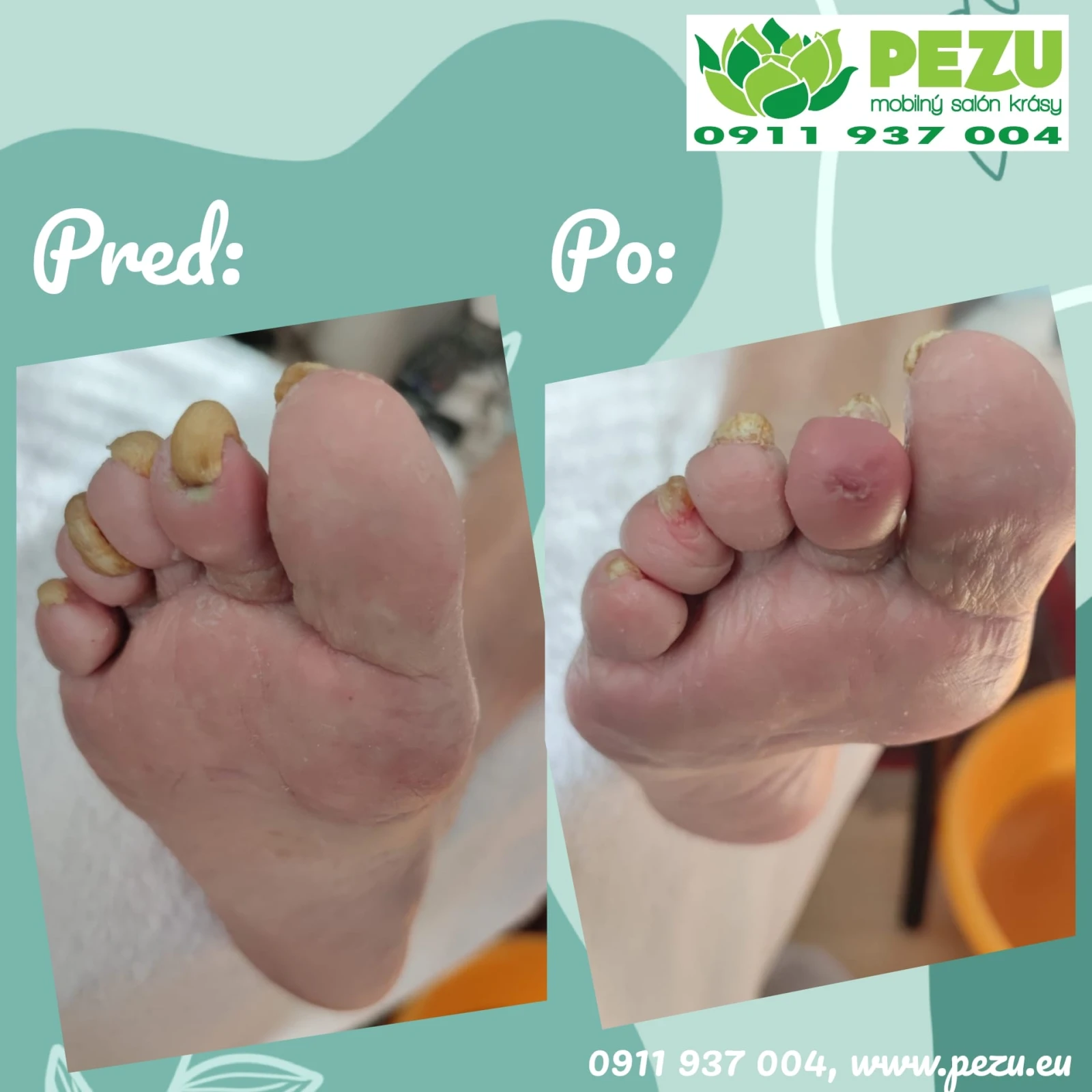 Mobilná mokrá pedikúra – ošetrenie chodidiel doma Bratislava